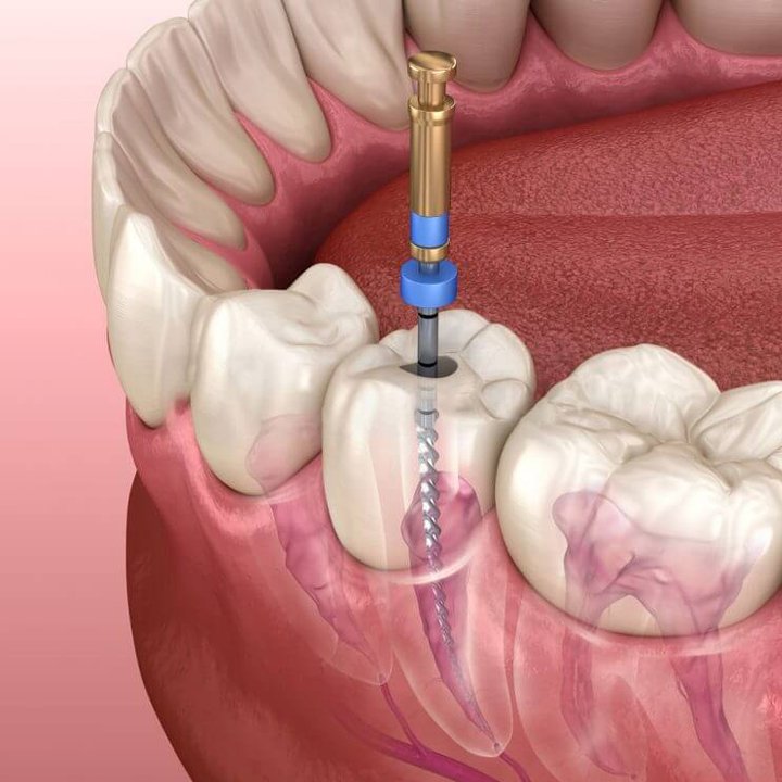 Endodonti